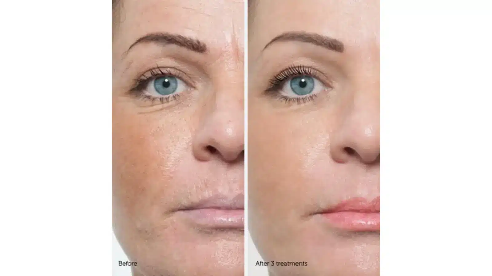 Side-by-side comparison of a woman's face before and after treatments. The "before" image shows more visible wrinkles and uneven skin texture, while the "after" image shows smoother skin with reduced lines and a more even complexion.