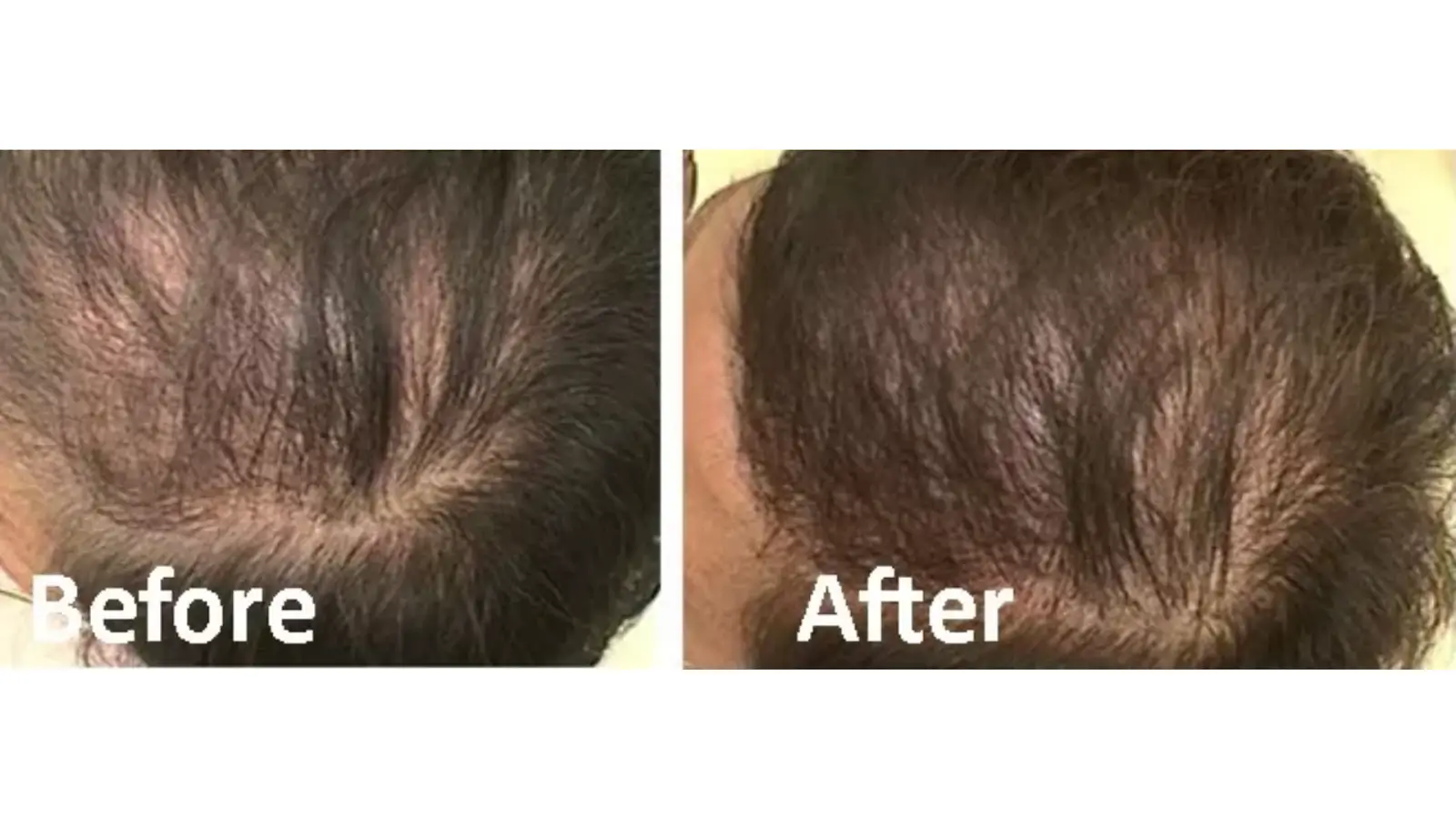 A side-by-side comparison showing the top of a person's head. The left image, labeled "Before," shows sparse hair and a visible scalp. The right image, labeled "After," shows thicker hair coverage and a less visible scalp.