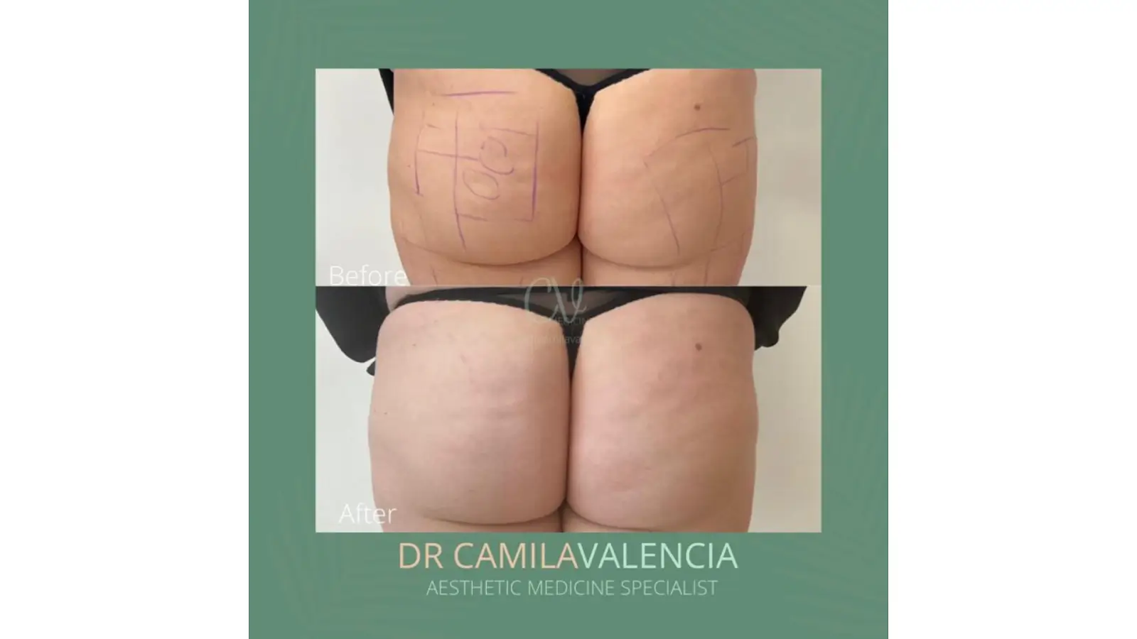 Before and after comparison of a cosmetic procedure on buttocks. The top image shows markings on the skin, while the bottom image shows smoother skin. 