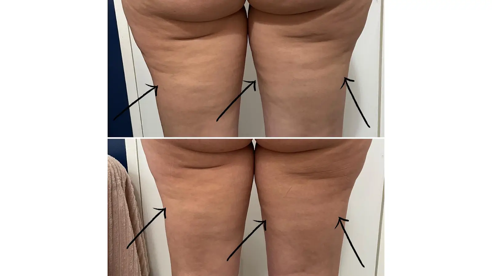 Two side-by-side images comparing the back of thighs before and after treatment. The top image shows more noticeable cellulite, while the bottom image shows smoother skin. Black arrows point to specific areas of the thighs in both images.