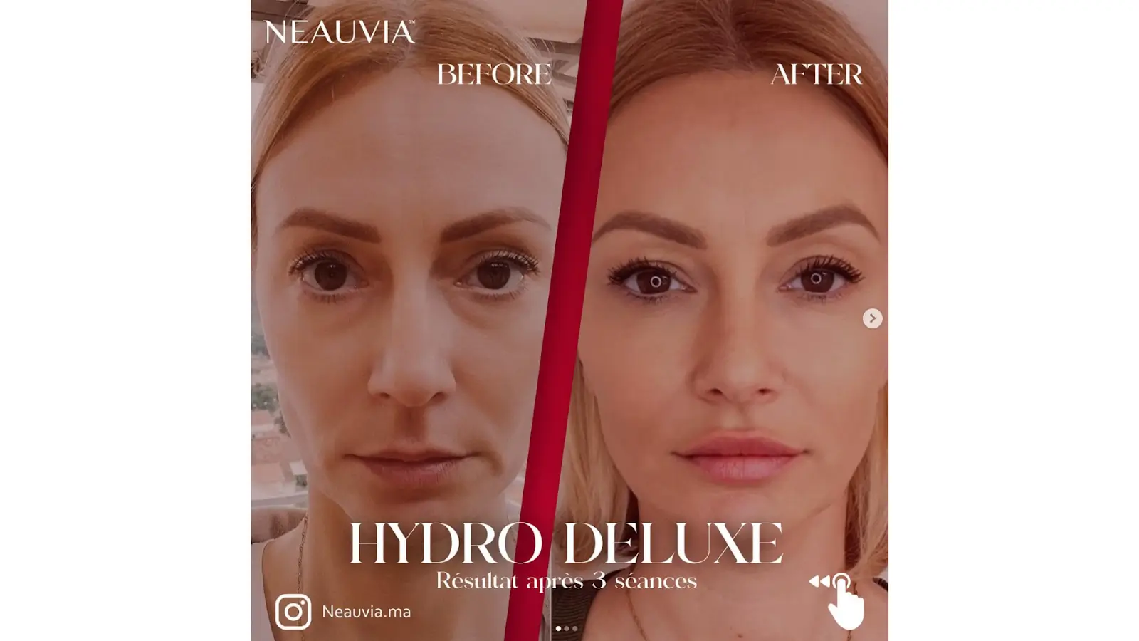 Split image showing a woman's face before and after a beauty treatment. The left side, labeled "Before," shows fewer enhancements. The right side, labeled "After," shows smoother skin.