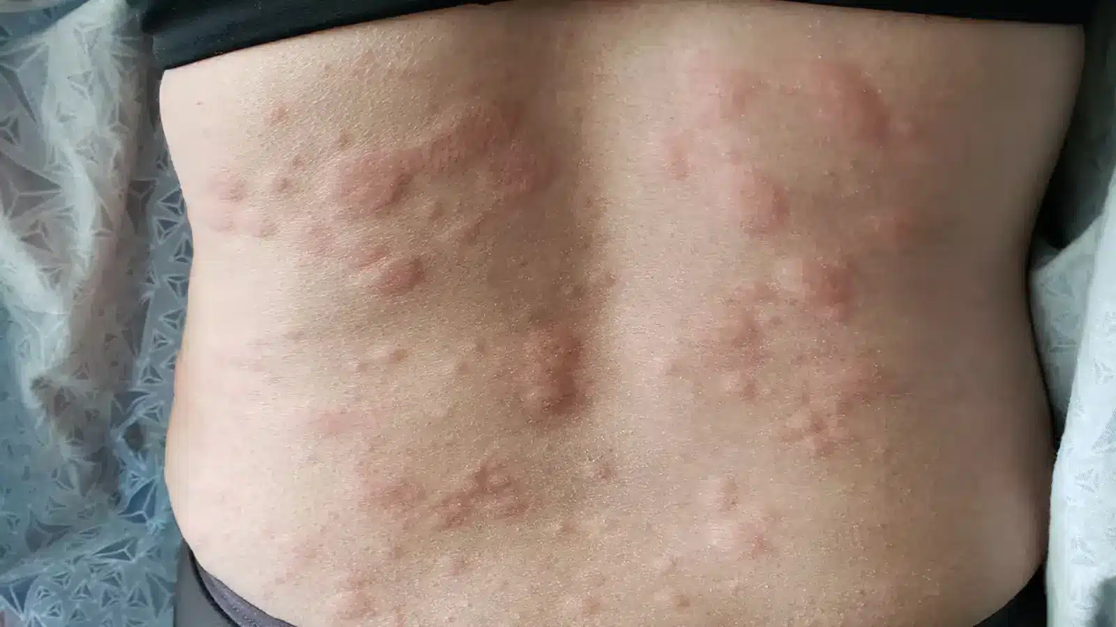 A close-up of a rash with red, raised bumps. The skin appears irritated and inflamed, with patches distributed across the whole area.