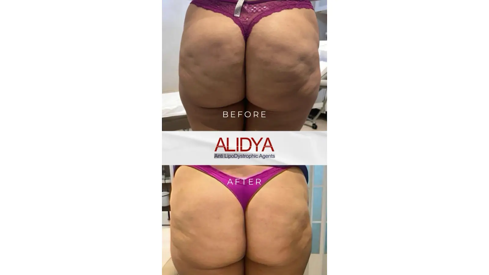 Before and after image showing the effects of a treatment on the skin. The top half shows legs and thighs with visible cellulite, while the bottom half shows the same area with smoother skin. A banner with text "ALIDYA" separates the images.