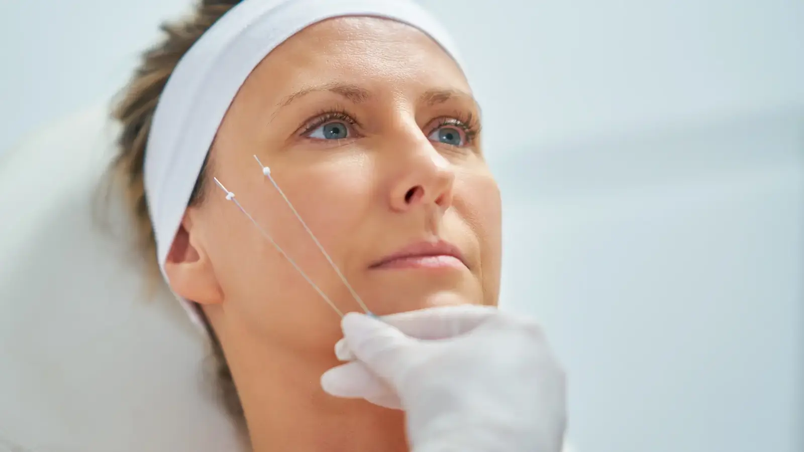 A person wearing a white headband is undergoing a cosmetic acupuncture procedure. A gloved hand holds two needles near their cheek against a plain background. The person appears calm and focused.