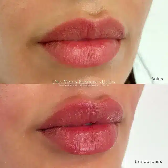 Close-up photo of lips before and after a cosmetic procedure. The first image shows natural lips, while the second shows fuller, enhanced lips. The text indicates "Antes" for the first image and "1 ml después" for the second.