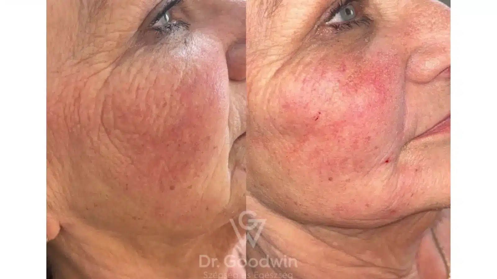 Side-by-side comparison of an older person's face showing skin texture. The left image shows more pronounced wrinkles, while the right image shows smoother skin with a reddish hue.