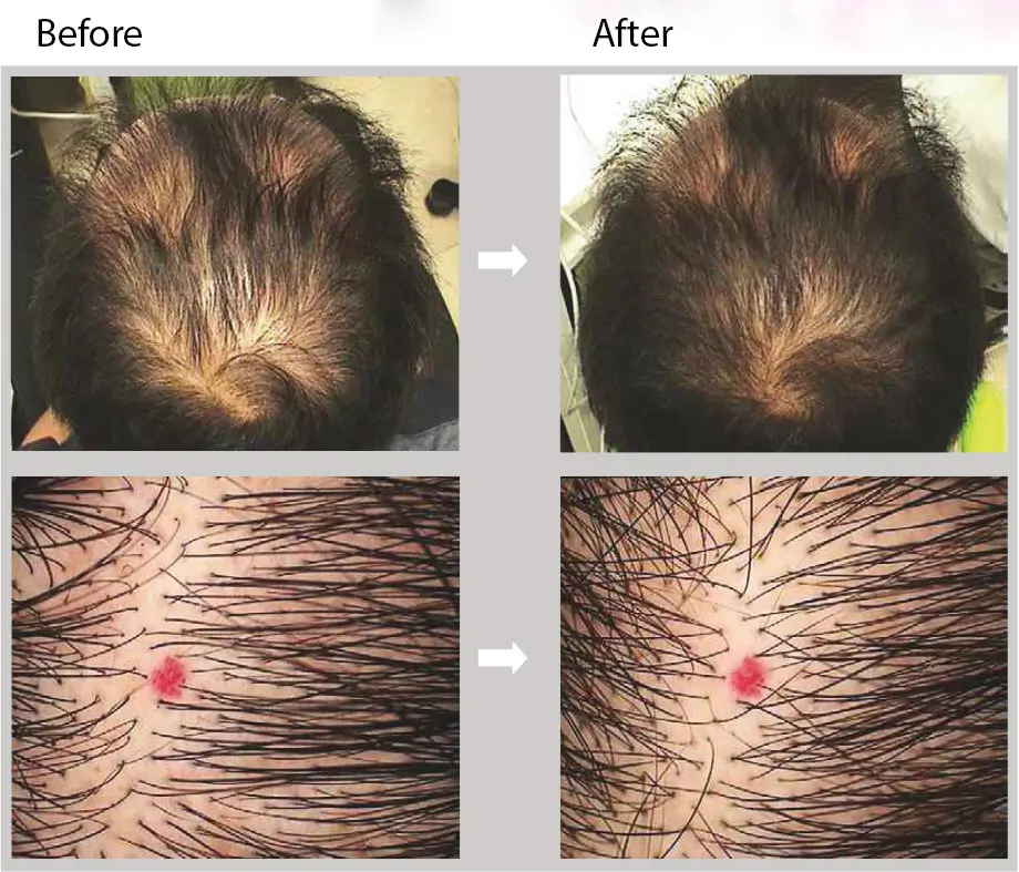 Before and after comparison of a scalp treatment. The top images show hair density improvement, with the "before" image displaying noticeable thinning and the "after" image showing thicker hair coverage. Bottom close-ups show scalp detail enhancements.