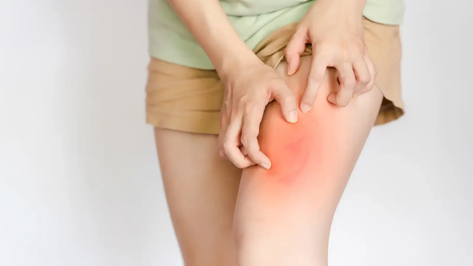 A person scratching their red, irritated skin on the thigh, wearing light brown shorts and a light green shirt. The background is plain white.