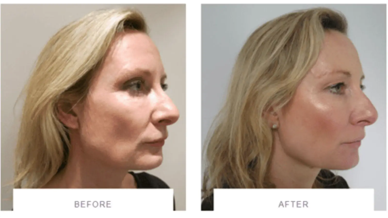 Side-by-side comparison of a woman's profile before and after a facial treatment. The "before" image shows visible signs of aging, while the "after" image shows smoother, more radiant skin.