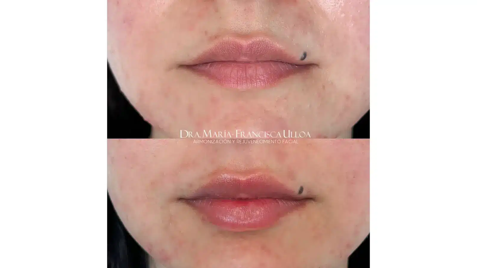 Close-up comparison of a person's lower face, showing lips and chin before and after a procedure. The top image has less full lips, and the bottom image shows fuller lips. There's a prominent mole on the upper lip in both images.