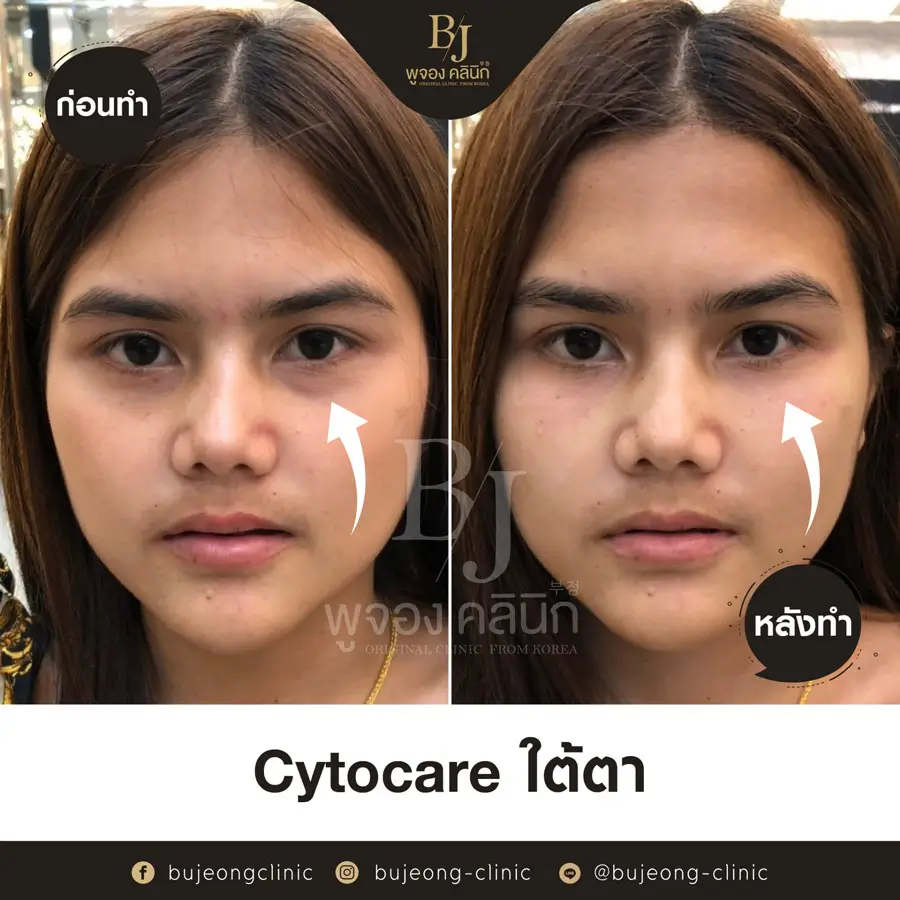 Side-by-side before and after images of a woman's face showcasing improvements in under-eye areas.