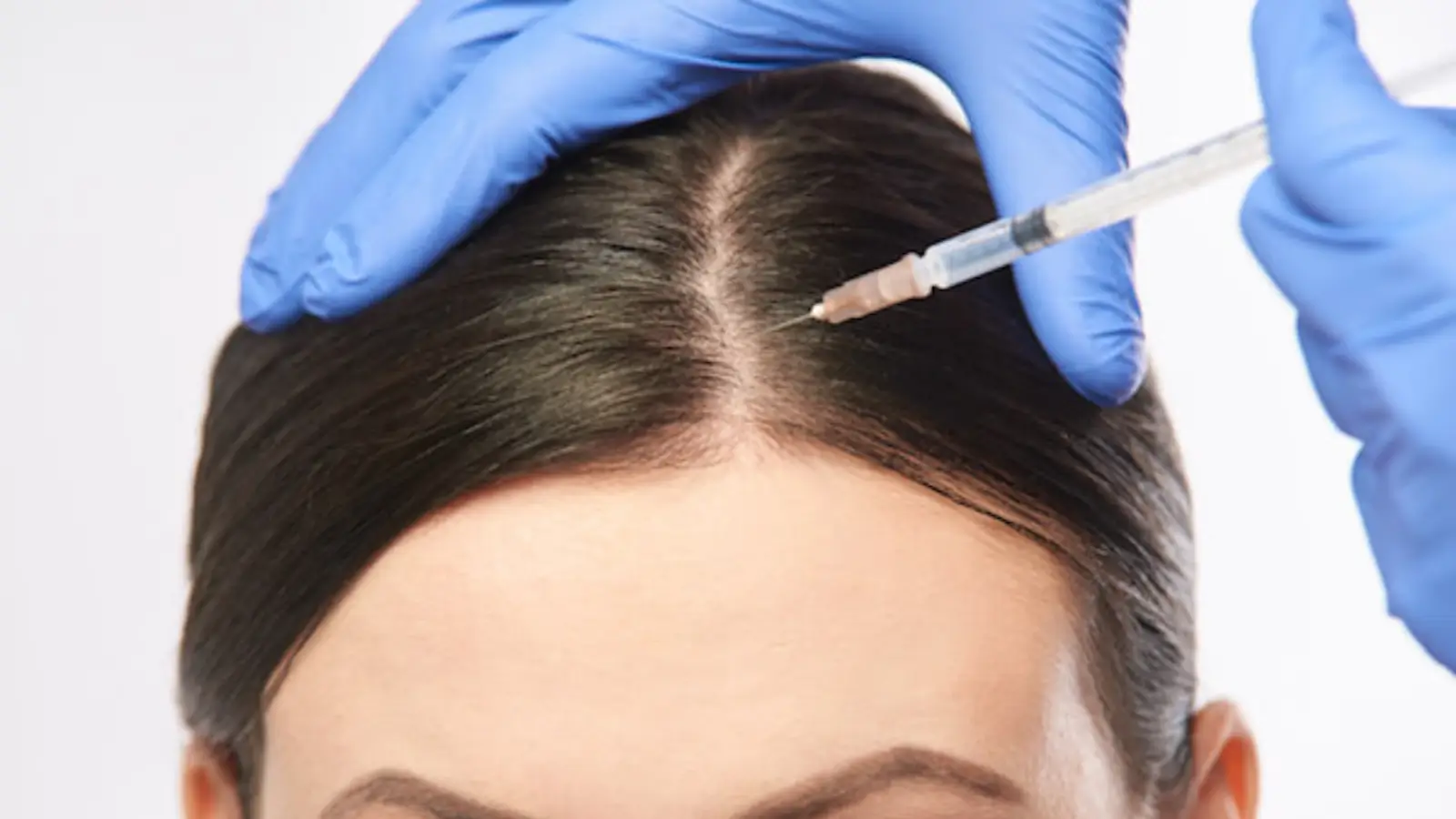 A person with dark hair is receiving an injection into their scalp. The person administering the injection is wearing blue gloves. The background is plain and light-colored.