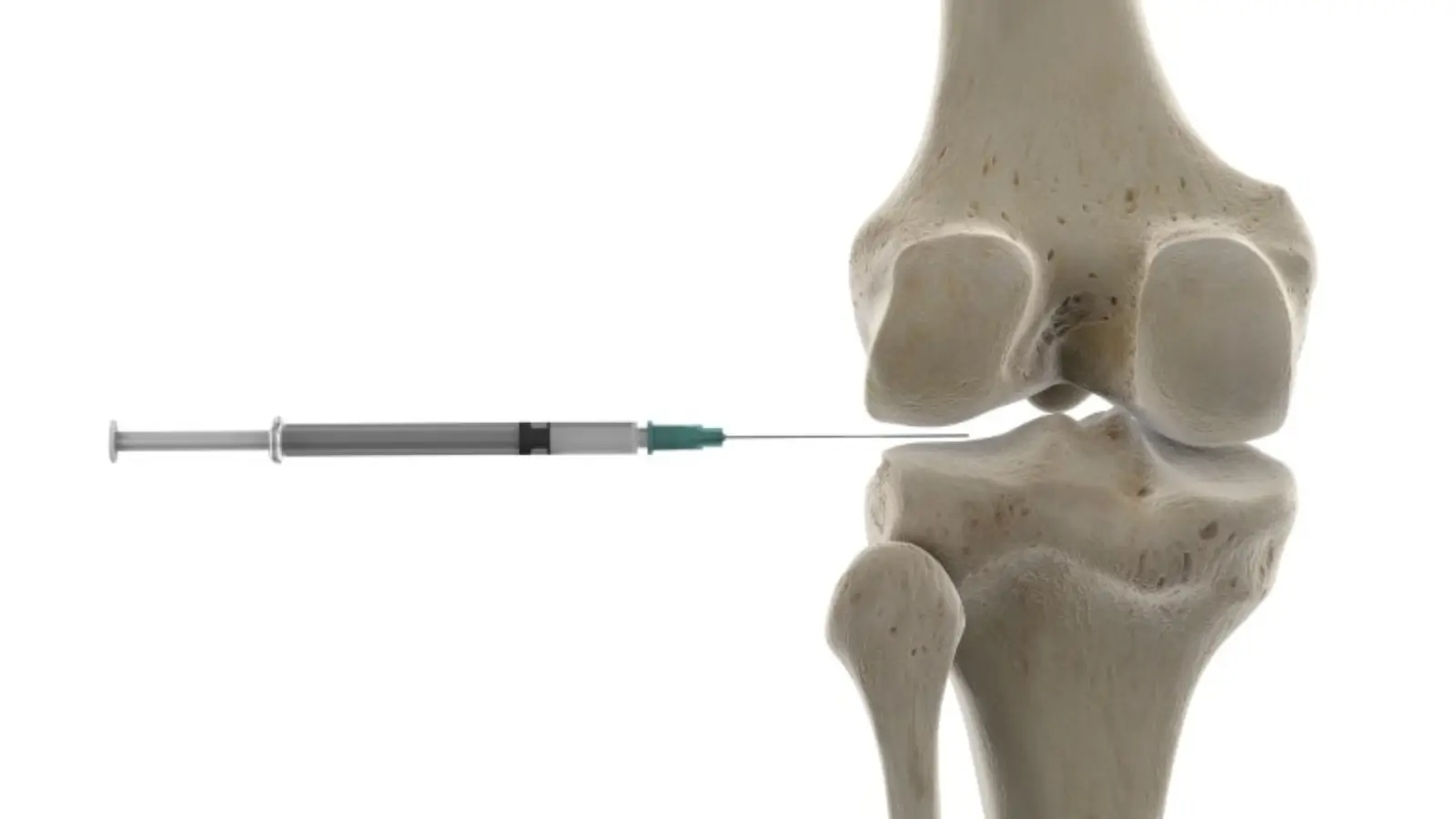 A syringe is injected into a knee joint model.