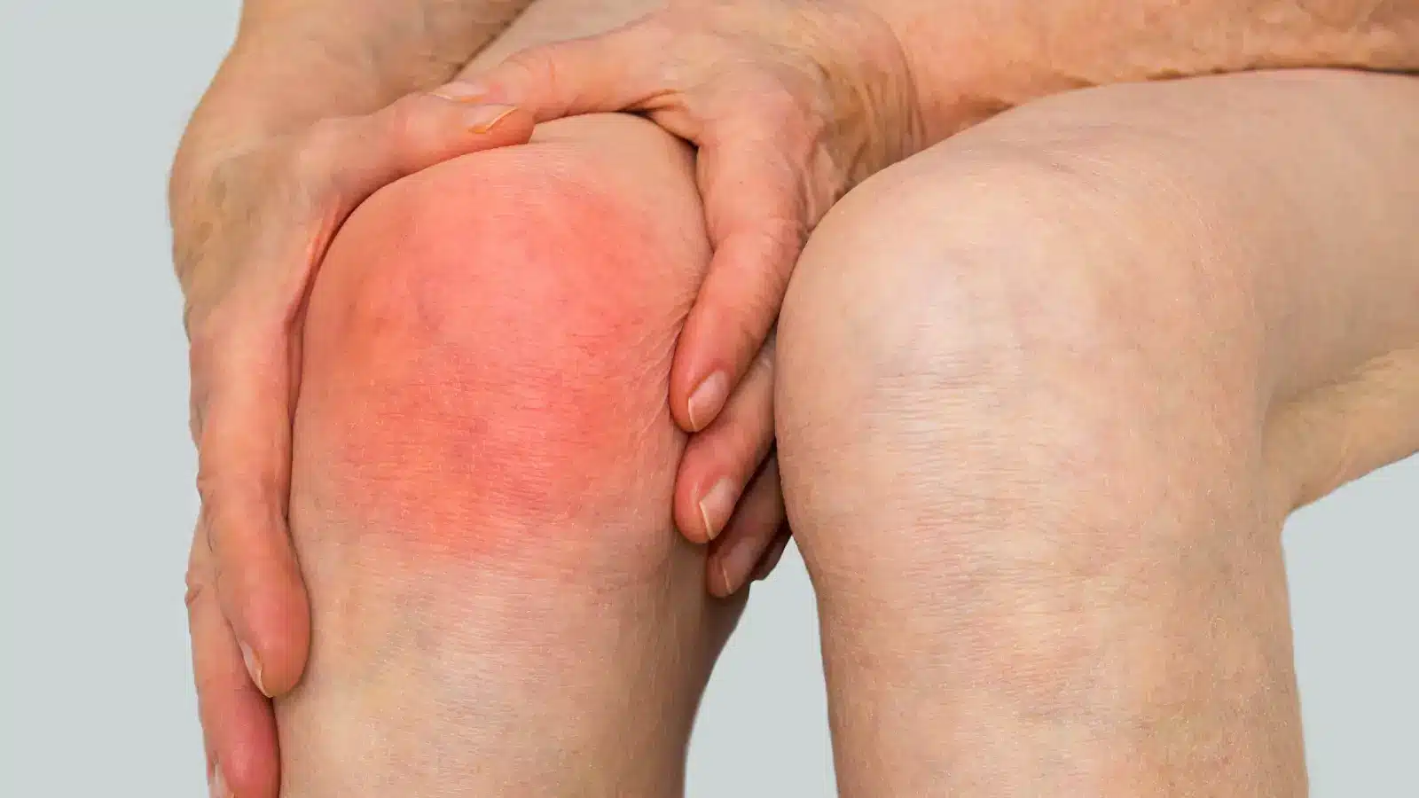 Close-up of a person holding their left knee, which appears red and inflamed, possibly indicating pain or swelling.