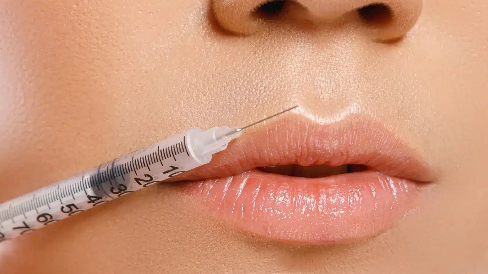 Close-up of lips with a syringe about to administer an injection into the upper lip. 