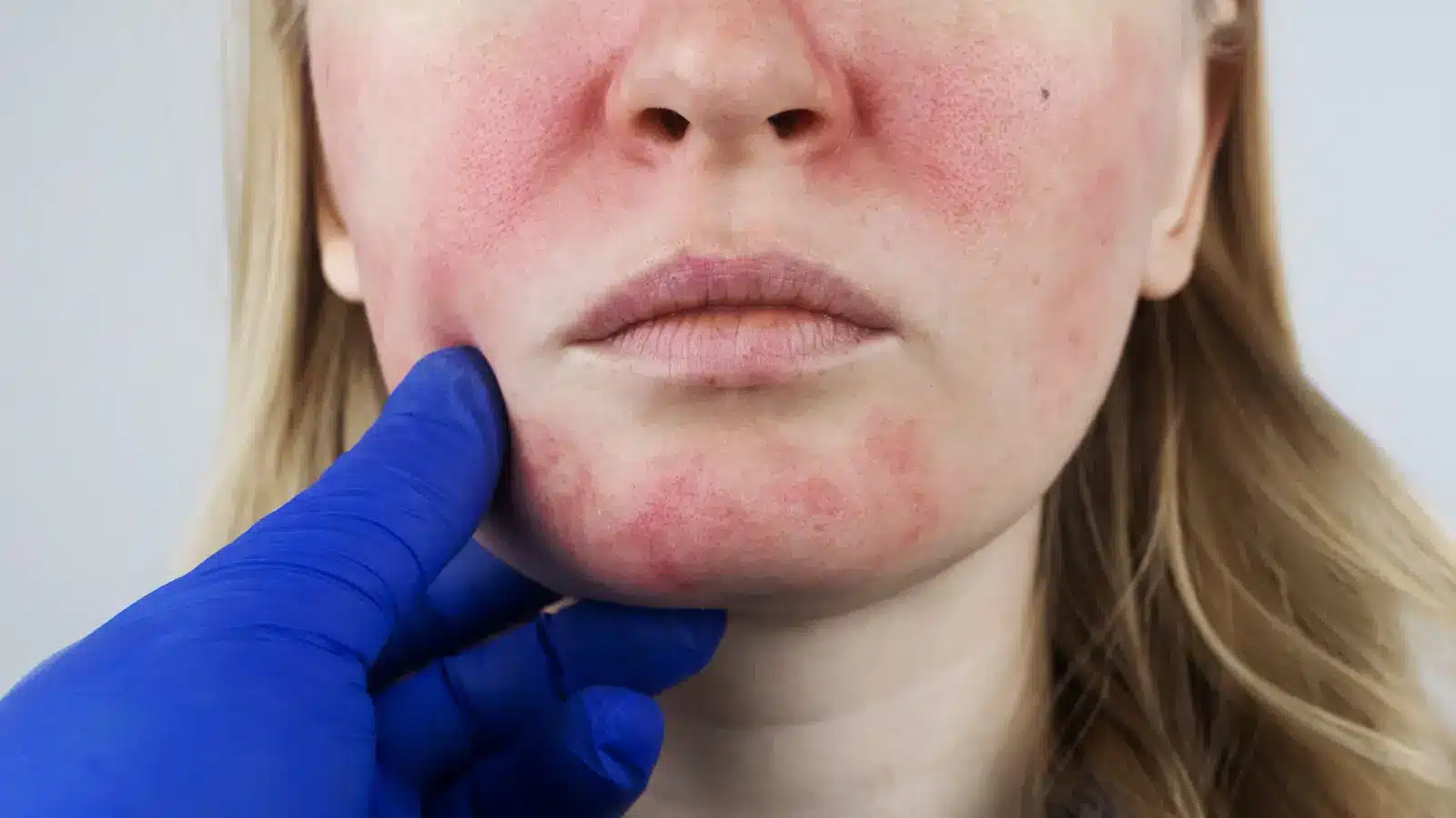 A person with visibly red and irritated skin on their face is being examined by a healthcare professional.