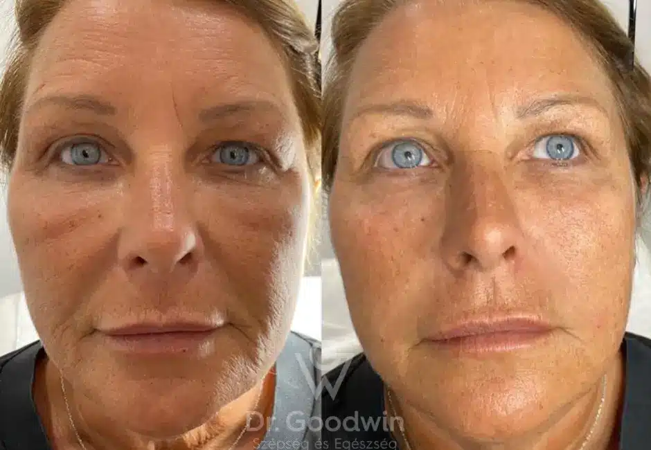 Side-by-side images of a woman's face, showing a comparison of skin texture and tone. The left image has more wrinkles and uneven skin, while the right image appears smoother and more even. 