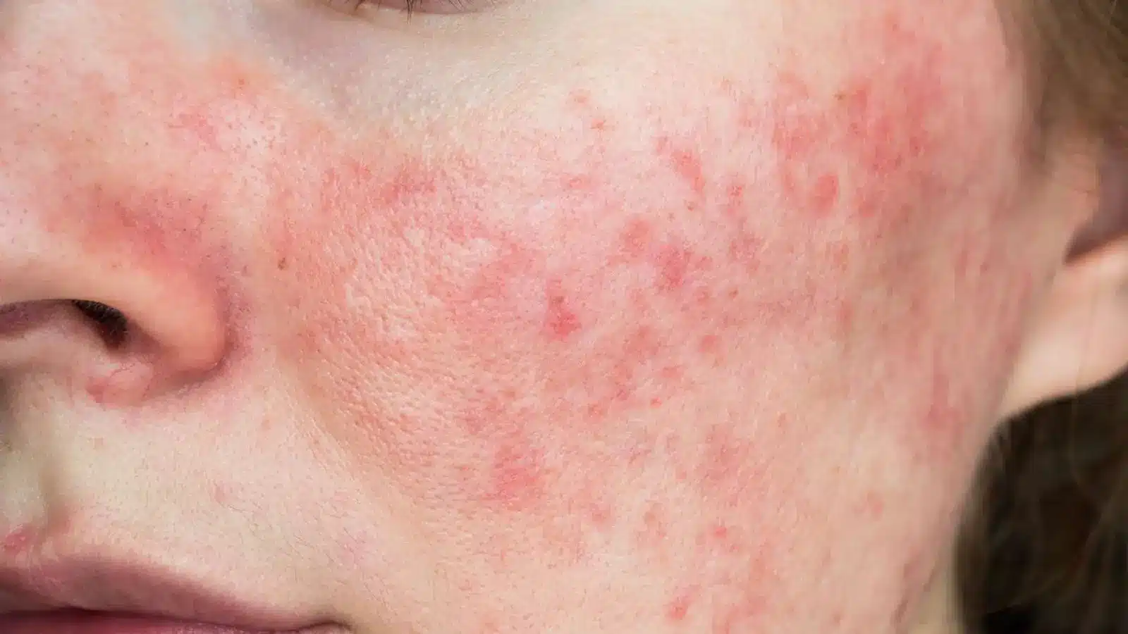 Close-up of a person's cheek showing red, inflamed skin with rash. The skin texture appears uneven, and the redness is concentrated on the cheek area.