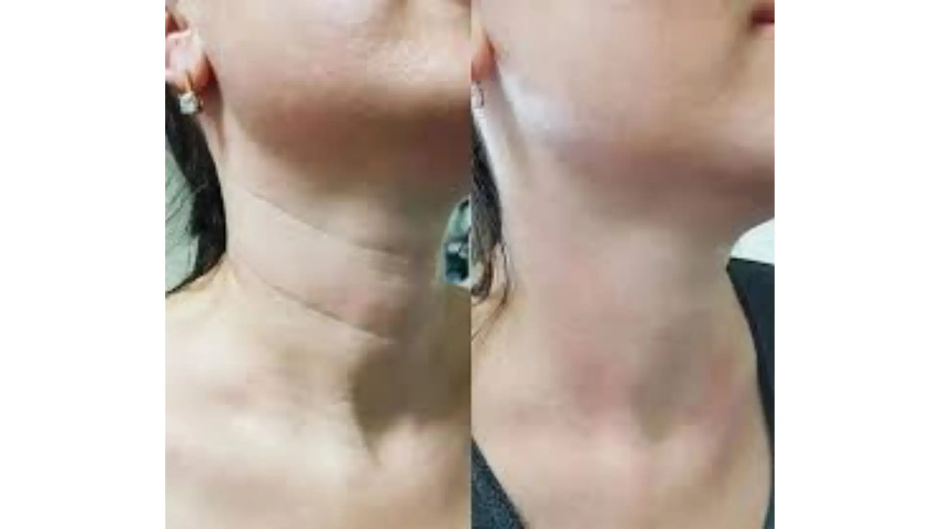 Side-by-side comparison of a person's neck before and after a skincare treatment. The left image shows sagging skin, while the right image depicts smoother and firmer skin.