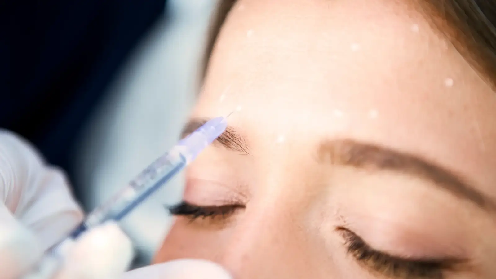 A close-up of a person receiving an injection on the forehead. The person has closed eyes and medical gloves holding a syringe. White dots are marked as guides on the skin.