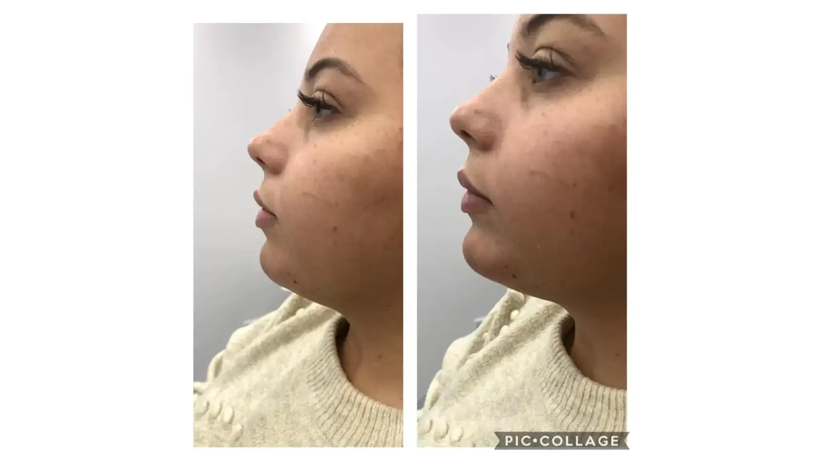 Side-by-side comparison of a person's face in profile, showing changes in their jawline and chin. The left image shows a softer profile, while the right image shows a more defined jawline. The person is wearing a light-colored sweater.