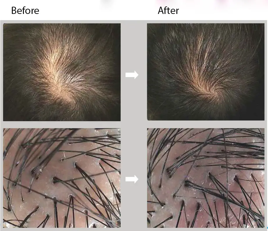 Comparison of a scalp before and after treatment. The top images show a reduction in visible thinning on the crown. The bottom images display a close-up of hair follicles, indicating increased hair density and growth in the after image.