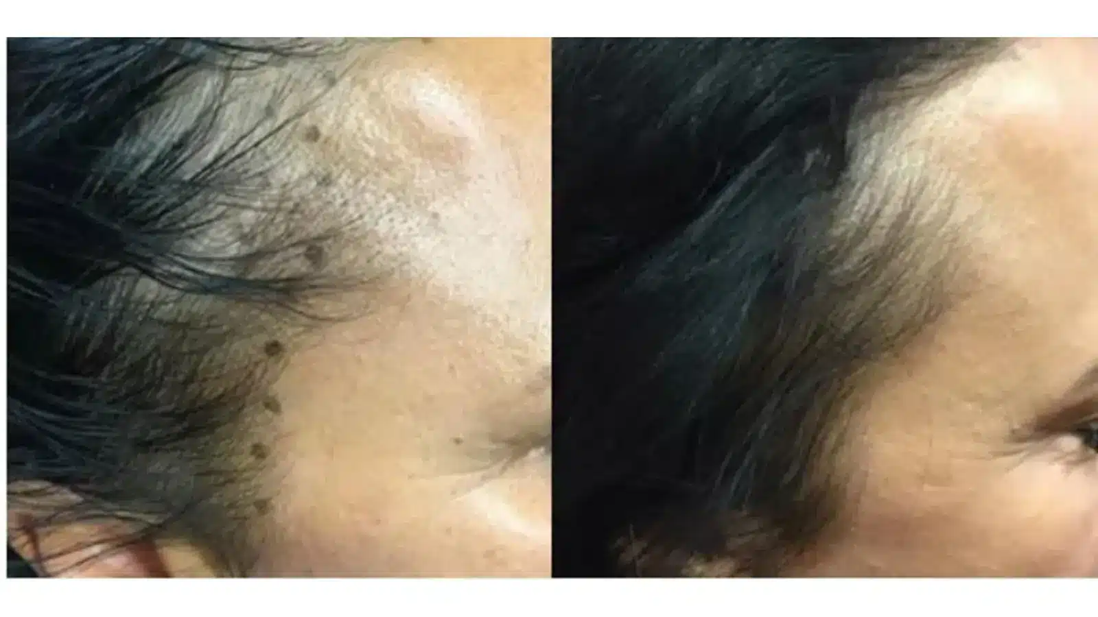 Side-by-side comparison of a person's hairline before and after treatment. The left image shows a receding hairline, while the right image shows noticeable hair growth and a fuller hairline.