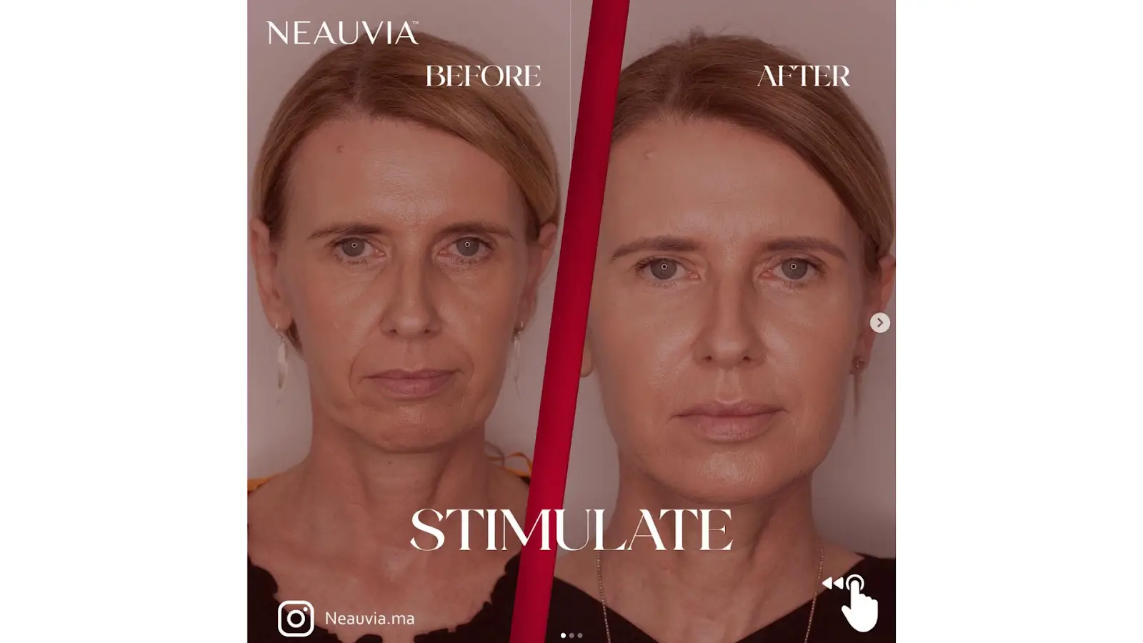 Split image showing a woman's face before and after a treatment. The left side is labeled "Before" and the right side "After." The "After" image shows a smoother complexion.