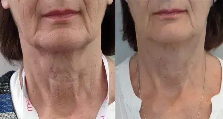 Side-by-side comparison of a woman's neck showing visible improvement in skin texture and tightness. The left image shows pronounced wrinkles, while the right image shows smoother and firmer skin.