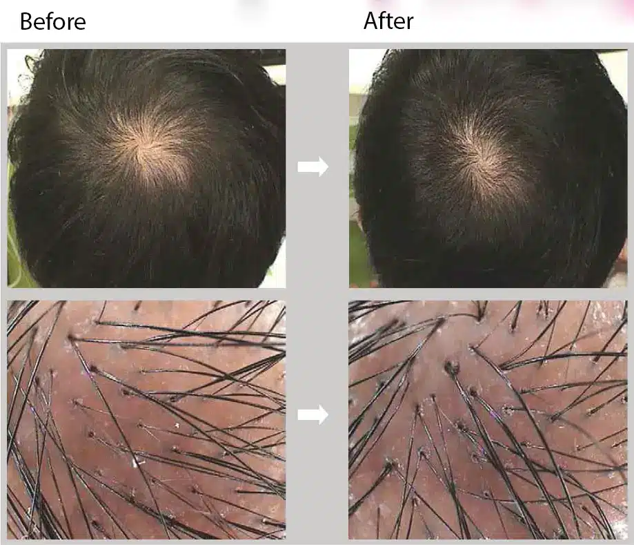 Before and after images of a scalp. The top row shows a wider view, while the bottom row offers a close-up. The "before" images show visible hair thinning, and the "after" images display noticeable hair regrowth. Arrows indicate the progression.