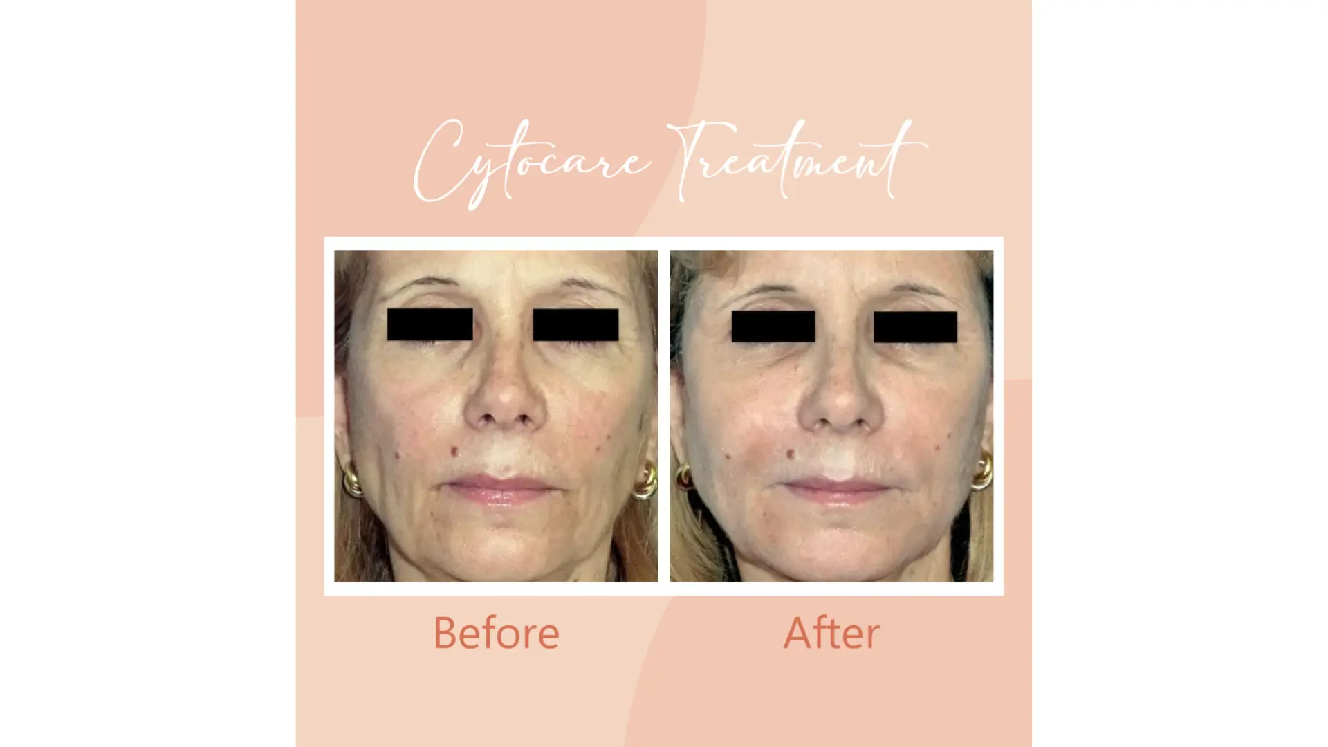 Side-by-side comparison of a woman's face before and after Cytocare treatment. The "before" image shows more visible facial marks and lines, while the "after" image shows a smoother complexion. Eyes are covered for privacy.