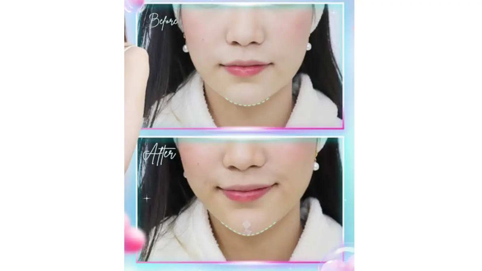 A before-and-after image showing a person's chin. The "before" section depicts a chin with a mark, while the "after" section shows a smooth chin. The borders are outlined in a pastel color, and there are decorative elements around the images.