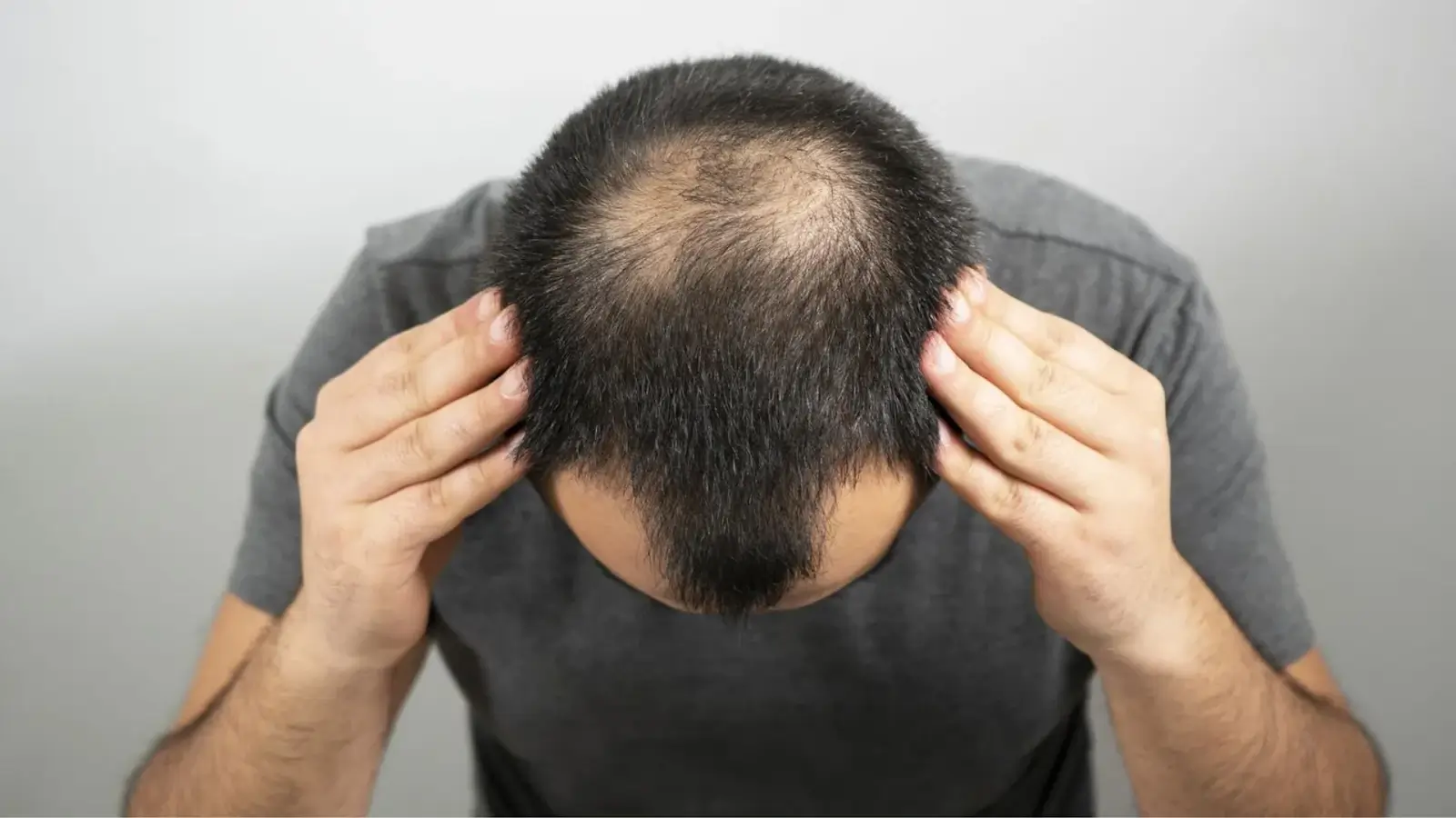 A person with short, dark hair is looking down, revealing thinning hair on the top of their head. They are wearing a gray shirt and have their hands on the sides of their head.